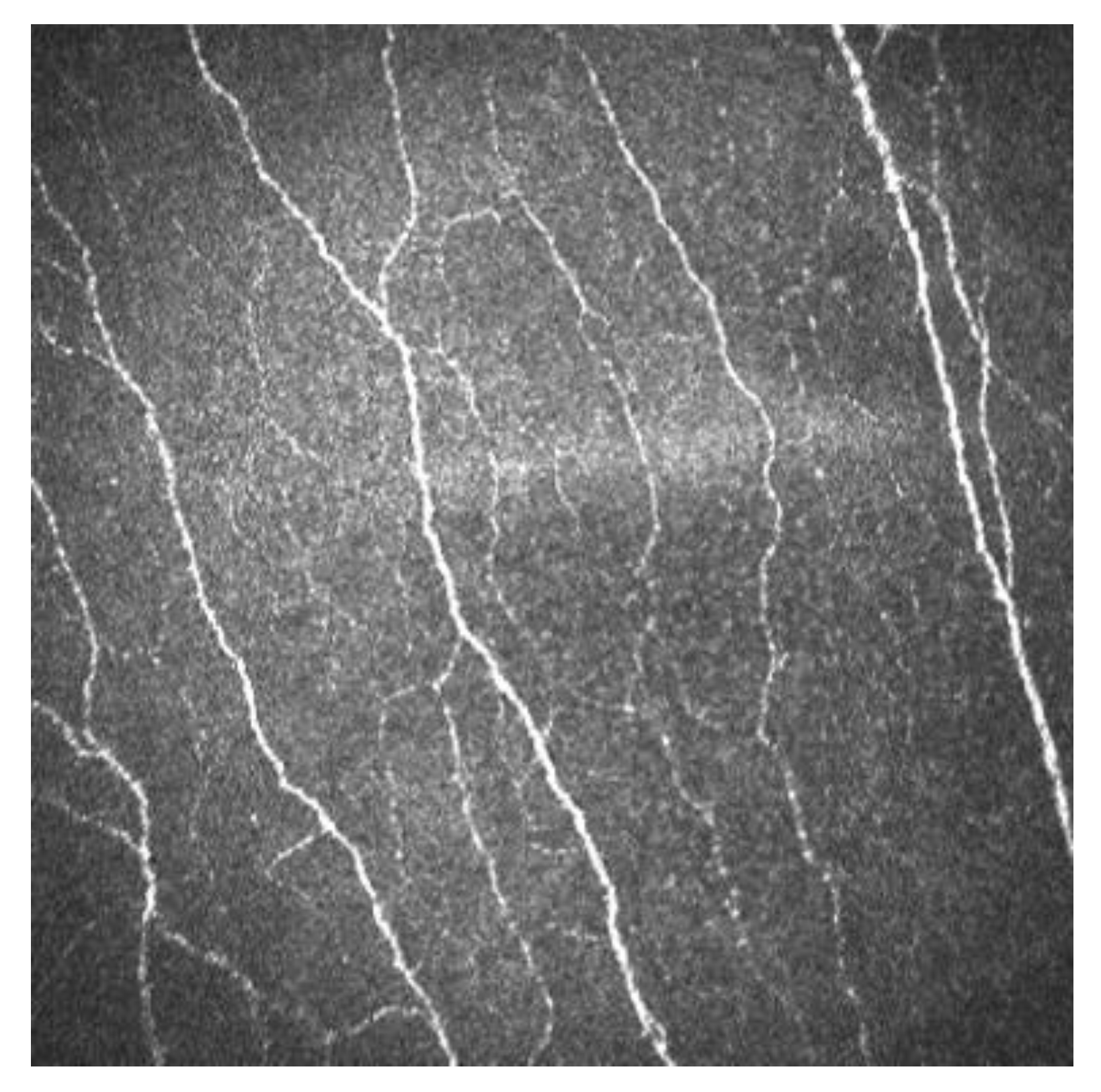 Subbasal Nerve Plexus